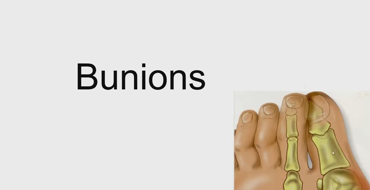 Common foot disorders in adults