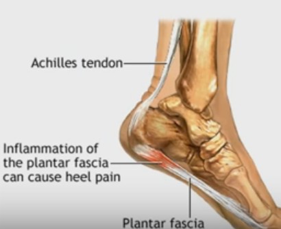 Plantar Fasciitis, Foot Pain Problems